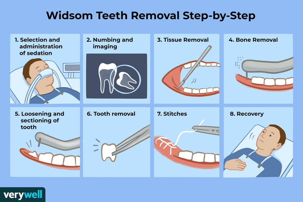 how to get over fear of wisdom teeth removal